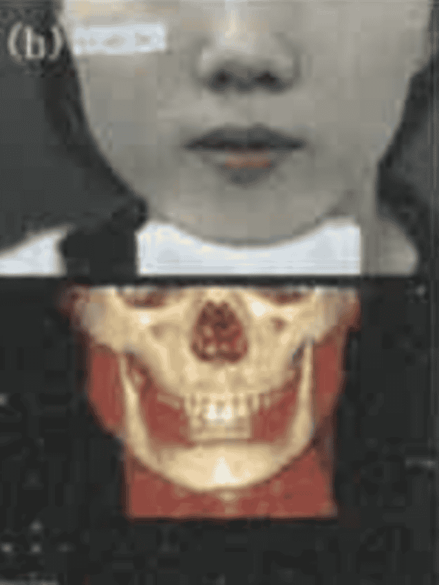 打肉毒後2個月 2 month period