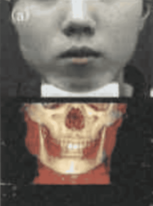 打肉毒前 pre op img
