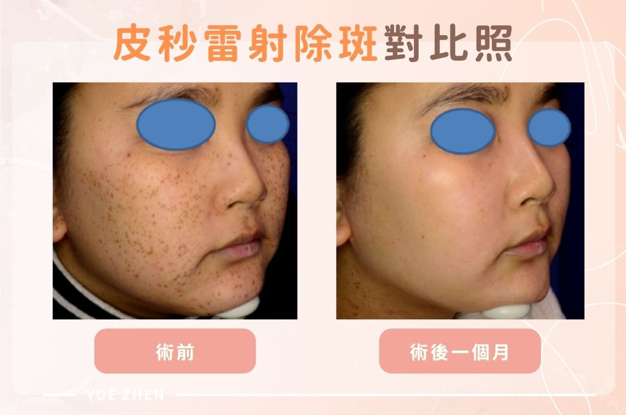 皮秒雷射案例 pigment lasers case img