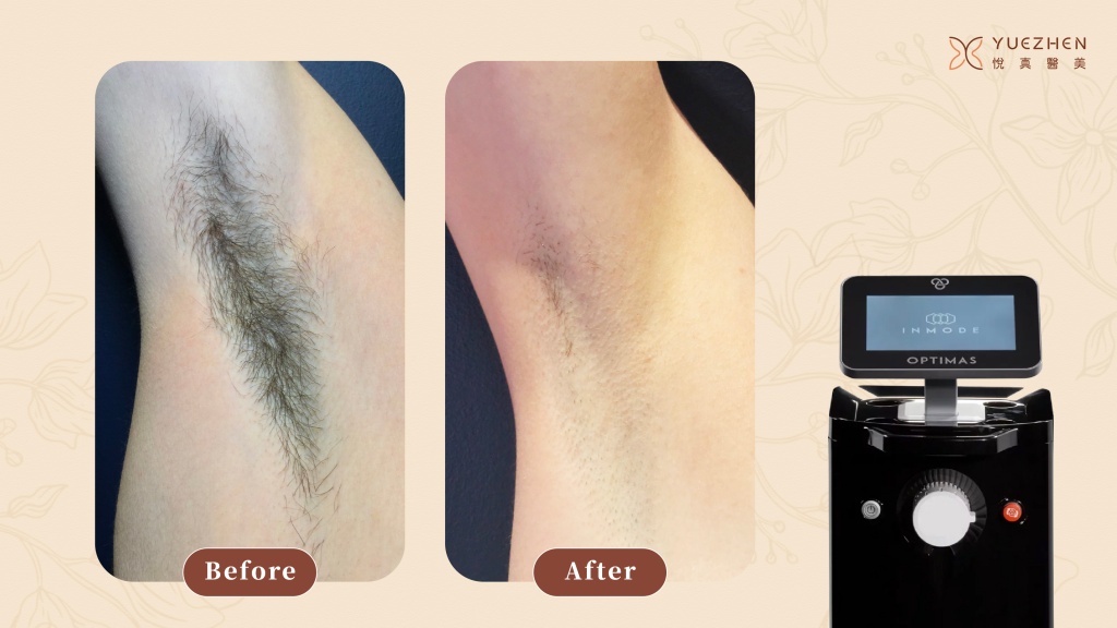 海神除毛全面解析|高雄醫美除毛推薦、原理、禁忌與術後照護說明 2 悅真醫美-海神除毛-實際除毛示意圖