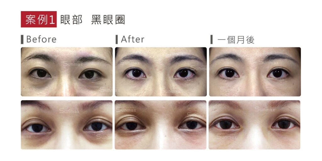 熊貓針是什麼?改善黑眼圈&淚溝的新選擇,一篇搞懂價格、功效!高雄熊貓針推薦 5 image 1 1