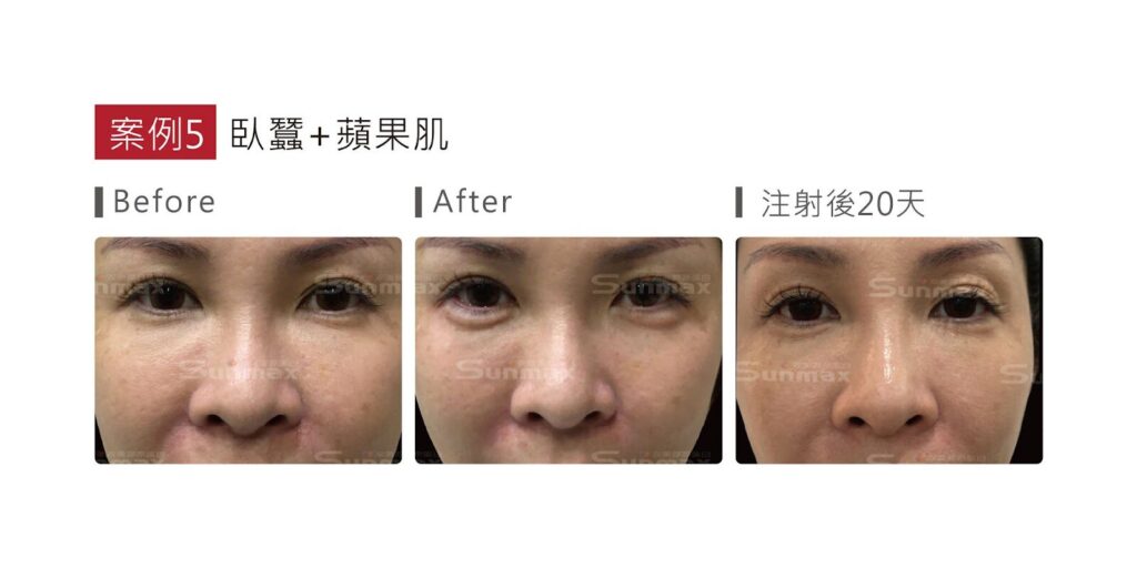 熊貓針是什麼?改善黑眼圈&淚溝的新選擇,一篇搞懂價格、功效!高雄熊貓針推薦 6 image 2