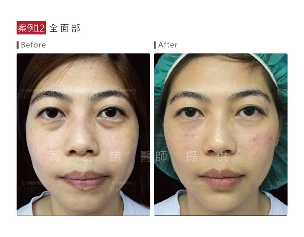 熊貓針是什麼?改善黑眼圈&淚溝的新選擇,一篇搞懂價格、功效!高雄熊貓針推薦 7 image 3 1