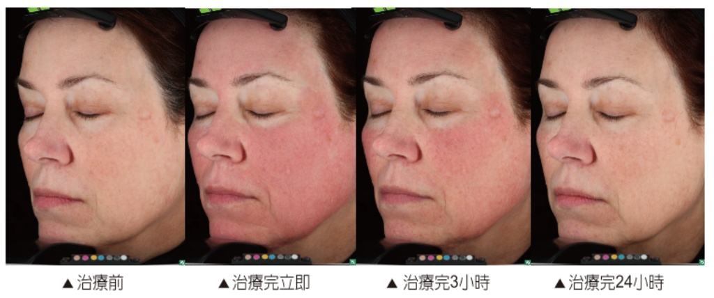 蜂巢皮秒是什麼?|高雄蜂巢皮秒價錢、功效、術後保養一次搞懂蜂巢皮秒會很痛嗎? 9 悅真醫美-蜂巢皮秒是什麼-術後恢復期短