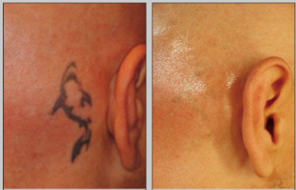 蜂巢皮秒是什麼?|高雄蜂巢皮秒價錢、功效、術後保養一次搞懂蜂巢皮秒會很痛嗎? 7 悅真醫美-蜂巢皮秒是什麼-刺青改善