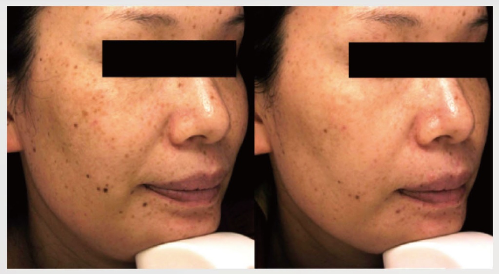 蜂巢皮秒是什麼?|高雄蜂巢皮秒價錢、功效、術後保養一次搞懂蜂巢皮秒會很痛嗎? 6 悅真醫美-蜂巢皮秒是什麼-去除黑色素與斑點.jpg