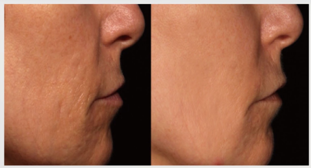 蜂巢皮秒是什麼?|高雄蜂巢皮秒價錢、功效、術後保養一次搞懂蜂巢皮秒會很痛嗎? 4 悅真醫美-蜂巢皮秒是什麼-改善毛孔與凹疤01