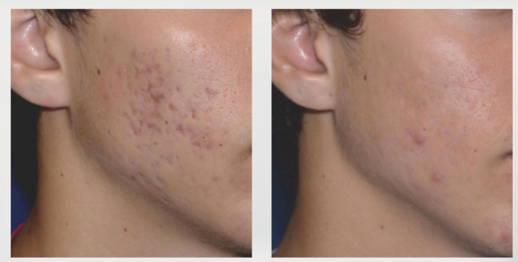 蜂巢皮秒是什麼?|高雄蜂巢皮秒價錢、功效、術後保養一次搞懂蜂巢皮秒會很痛嗎? 5 悅真醫美-蜂巢皮秒是什麼-淡化痘疤