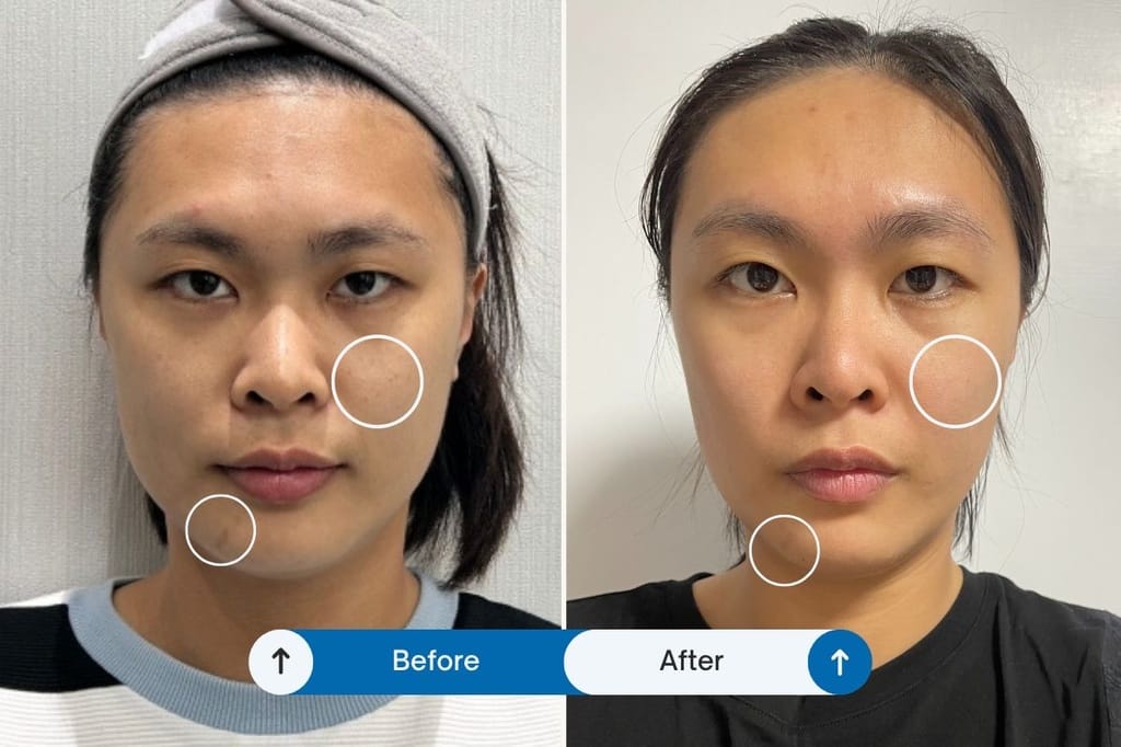 高雄醫美皮秒|神秘客體驗心得,皮秒雷射 755 施作流程全公開! 4 悅真醫美診所專文 32