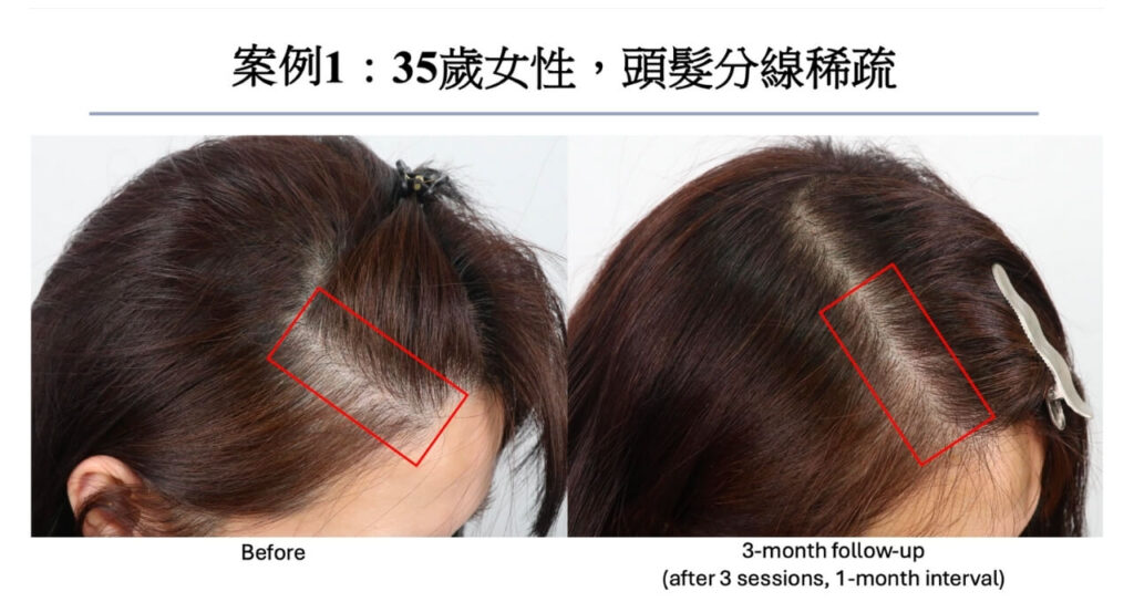 高雄外泌體生髮推薦|悅真醫美打造頭皮再生力,見證濃密新生 6 高雄外泌體生髮案例|頭髮分線稀疏(側邊頭髮分線)