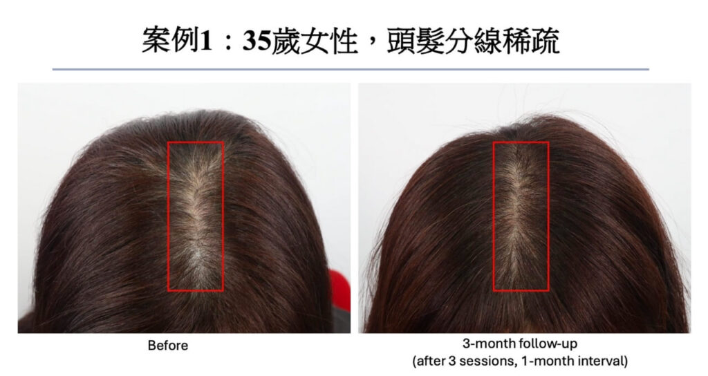 高雄外泌體生髮推薦|悅真醫美打造頭皮再生力,見證濃密新生 5 高雄外泌體生髮案例|頭髮分線稀疏(頭頂分線)