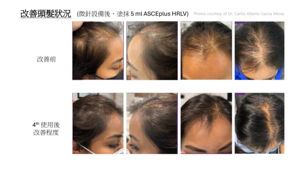 高雄外泌體生髮推薦|悅真醫美打造頭皮再生力,見證濃密新生 8 高雄外泌體生髮案例|女性頭頂髮量稀疏改善