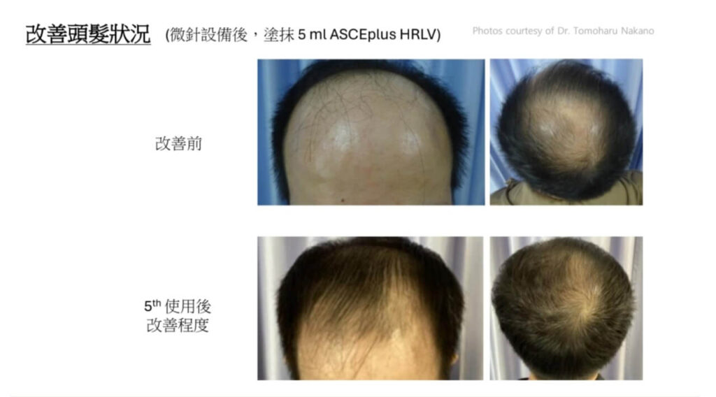 高雄外泌體生髮推薦|悅真醫美打造頭皮再生力,見證濃密新生 9 高雄外泌體生髮案例|男性髮際線後退、頭頂髮量稀疏改善