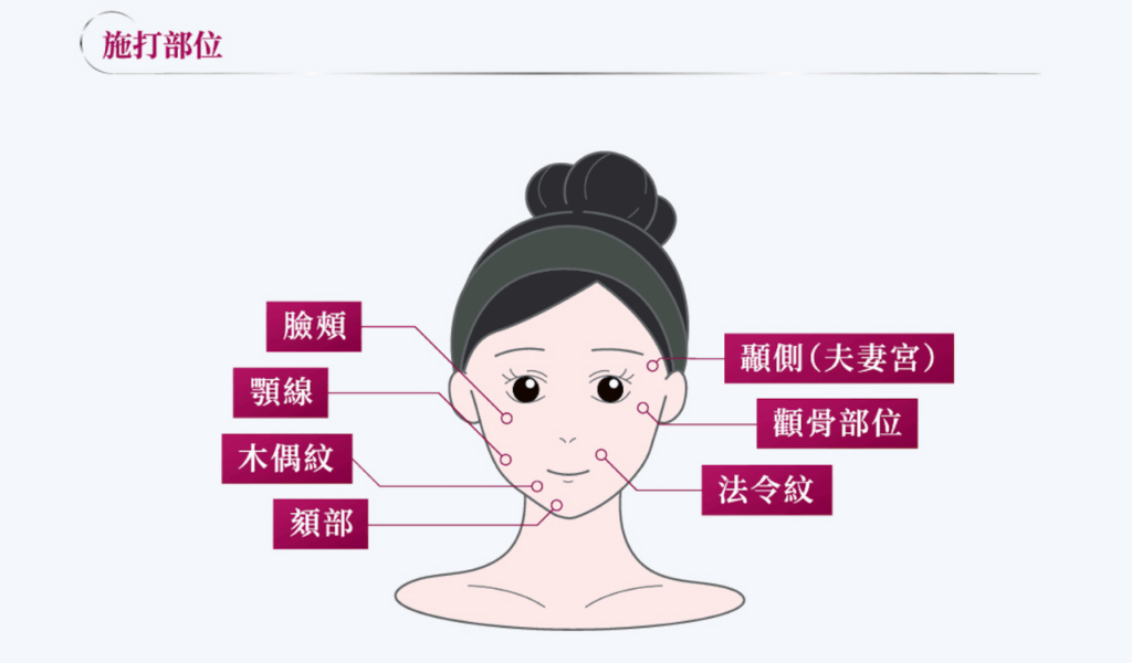 高雄童顏針Dcard常見問題完整解析|效果、價格、施打心得一次整理 2 童顏針適合施打部位